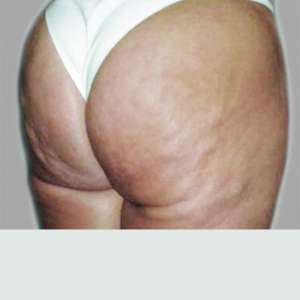 Cellulite peau d'orange - Avant