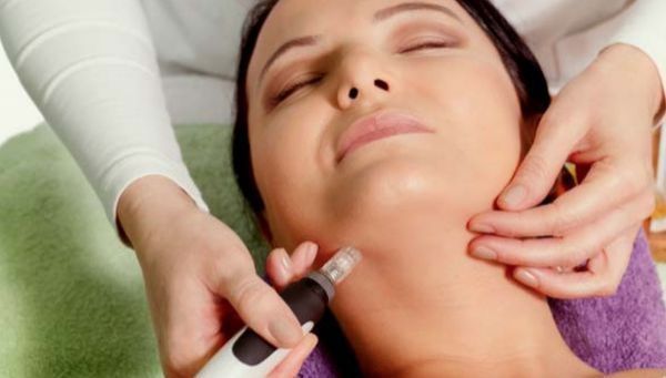 Micro needling (micropuncture)